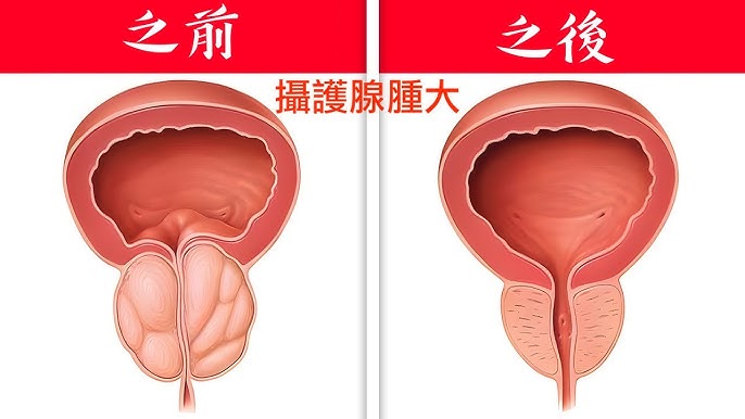 攝護腺腫大（BPH）